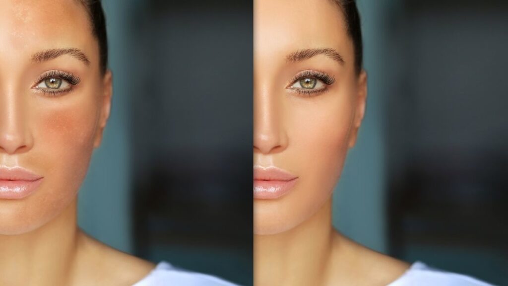 006432100_1619149652-Melasma_dan_Hiperpigmentasi_Apa_Bedanya