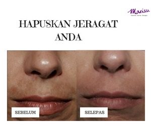 TESTIMONI-PIGMENTASI-5