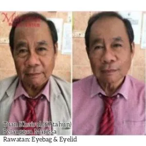 eyebag-rawataneyebag-testimoni1