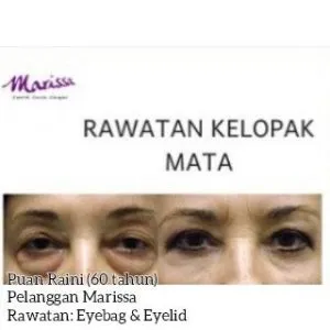 eyebag-rawataneyebag-testimoni2