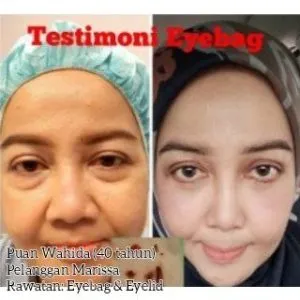 eyebag-rawataneyebag-testimoni3