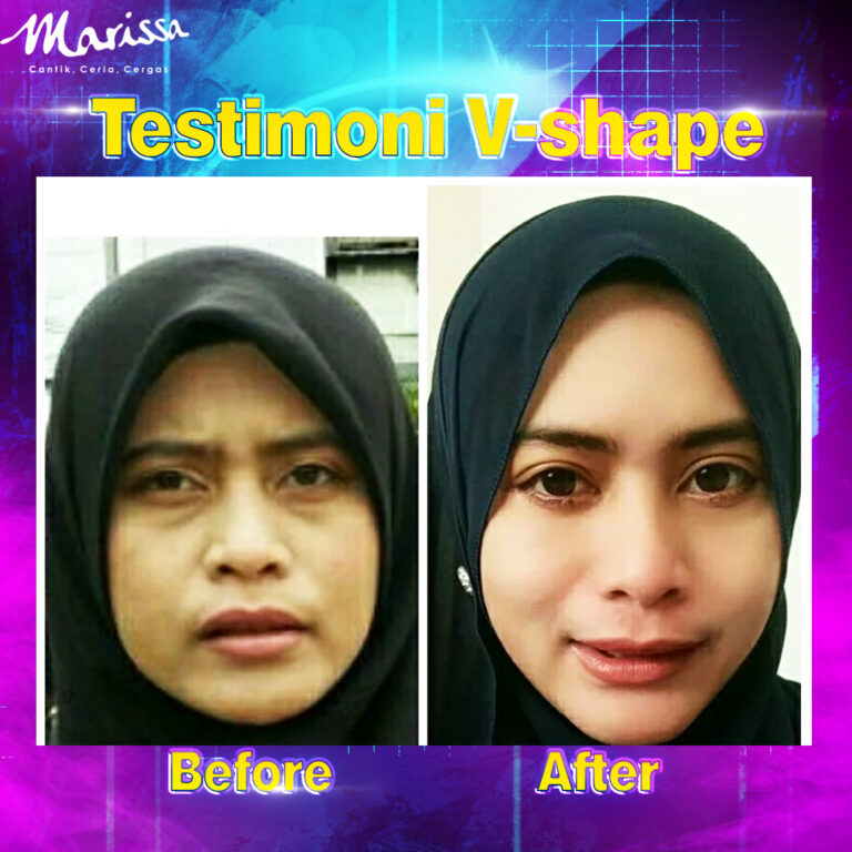 Vshape