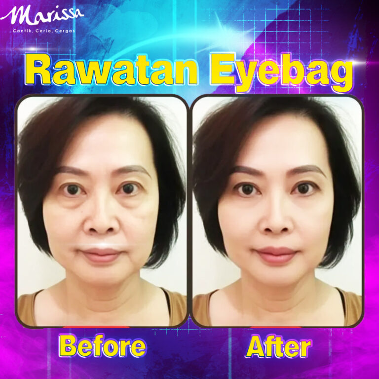 eyebag-testimoni