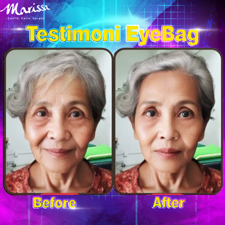 eyebag1