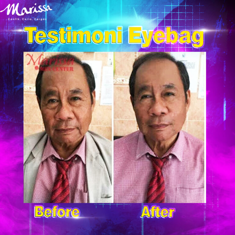 eyebag2