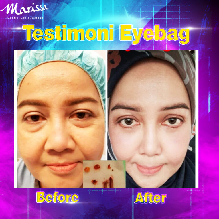 eyebag3