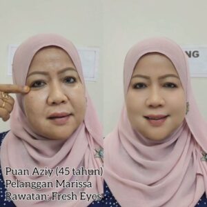 fresheye-testimoni-pnazey