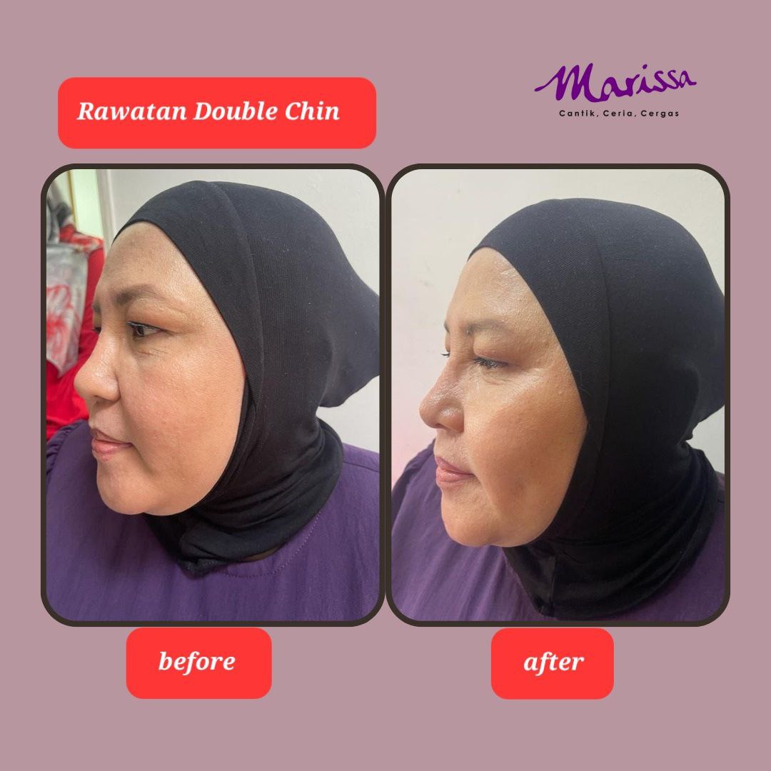 photo-testi-double-chin.jpg