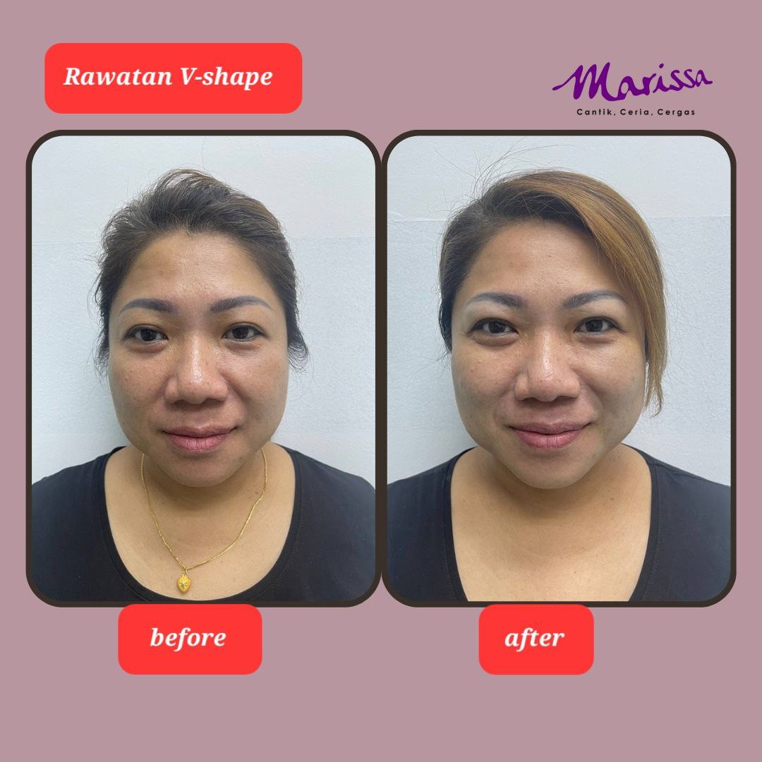 photo-testi-v-shape-2.jpg