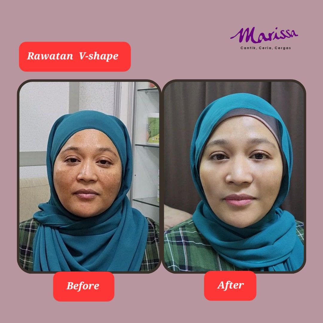 photo-testi-v-shape.jpg