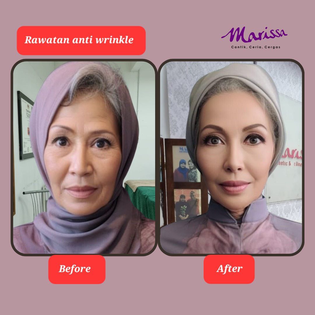 photo-testi-wrinkle.jpg